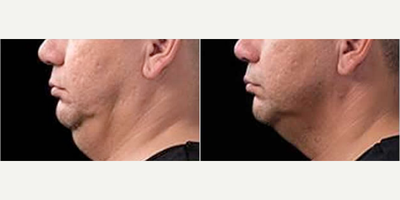 CoolSculpting before and after photo