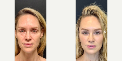 Neck Lift before and after photo
