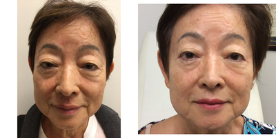 Skin Rejuvenation before and after photo