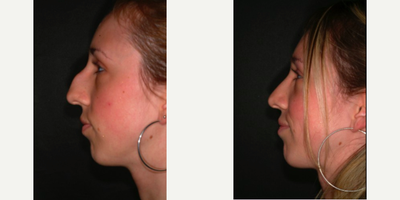 Rhinoplasty before and after photo