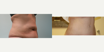 Tummy Tuck before and after photo