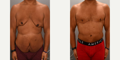Body Lift before and after photo