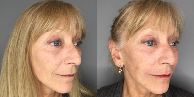 Dermal Fillers before and after photo