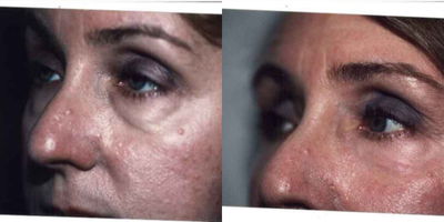 Eyelid Surgery before and after photo