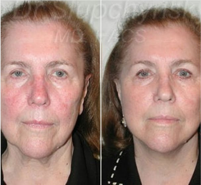 Facelift before and after photo