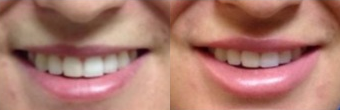 Lip Fillers before and after photo