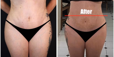 Tummy Tuck before and after photo