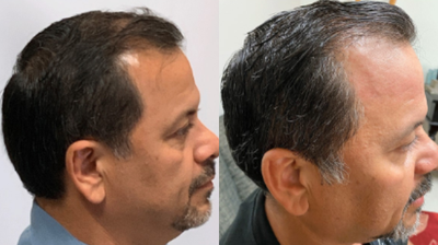 ARTAS Robotic Hair Transplant before and after photo