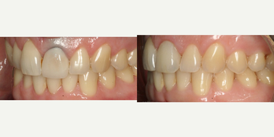 Dental Crown before and after photo