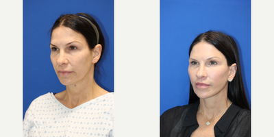Facelift before and after photo