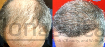 Hair Transplant before and after photo