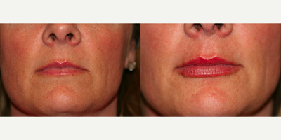 Juvederm before and after photo
