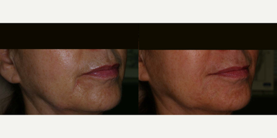 Juvederm before and after photo