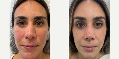 Rhinoplasty before and after photo