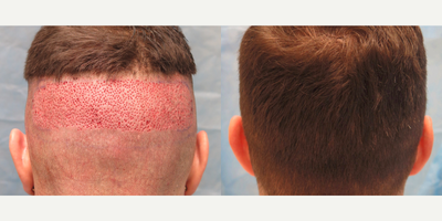 ARTAS Robotic Hair Transplant before and after photo