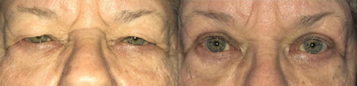 Brow Lift before and after photo