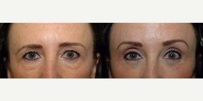 Brow Lift before and after photo