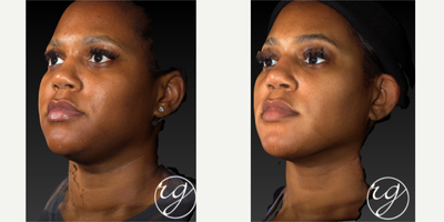 Buccal Fat Removal before and after photo