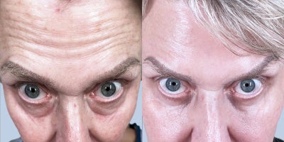 Eyelid Surgery before and after photo