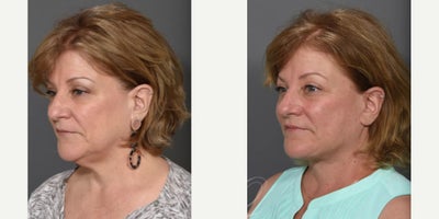 Facelift before and after photo