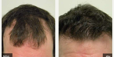 Hair Loss Treatment before and after photo