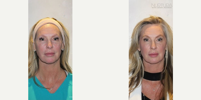 NuFace before and after photo