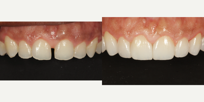 Porcelain Veneers before and after photo