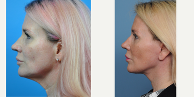 Facelift before and after photo