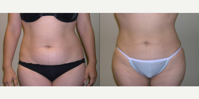 Liposculpture before and after photo