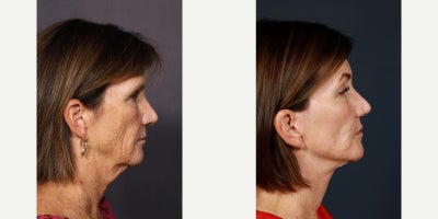 Neck Lift before and after photo