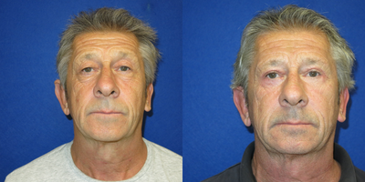 Eyelid Surgery before and after photo
