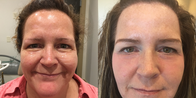 Laser Resurfacing before and after photo