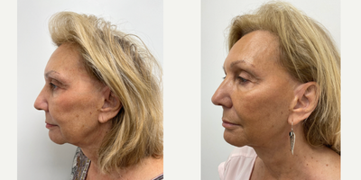 Morpheus8 before and after photo