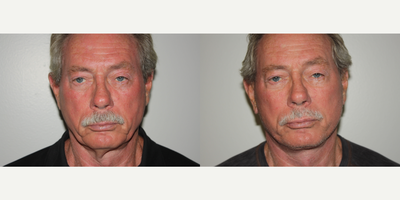 Neck Lift before and after photo