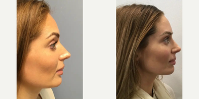 Rhinoplasty before and after photo
