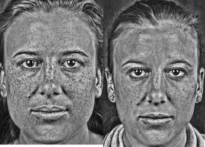 Skin Rejuvenation before and after photo