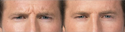 Botox before and after photo