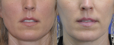 Botox before and after photo