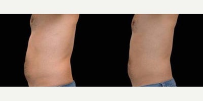 Emsculpt before and after photo