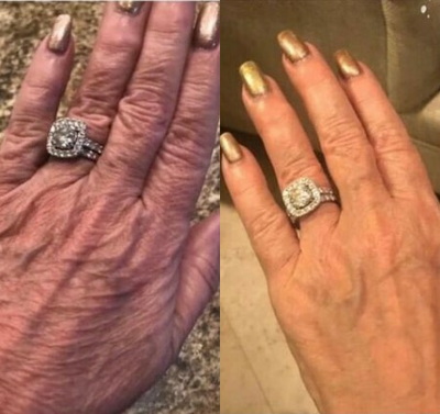 Hand Rejuvenation before and after photo