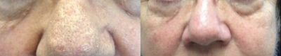 Laser Resurfacing before and after photo