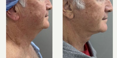 Neck Lift before and after photo