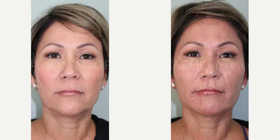 Radiesse before and after photo