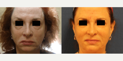 Skin Tightening before and after photo