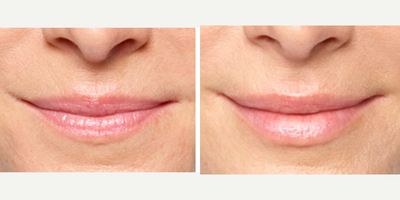 Volbella before and after photo