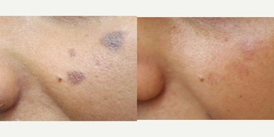 Chemical Peel before and after photo