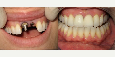 Dental Implants before and after photo