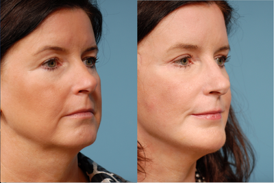 Facelift before and after photo