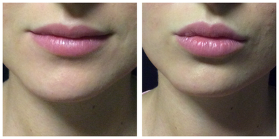 Juvederm before and after photo