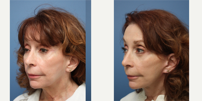 PrecisionTx before and after photo